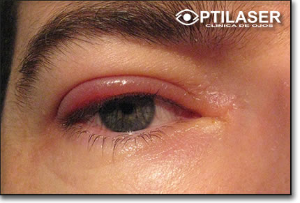 Clinica de ojos Optilaser - Blefaritis